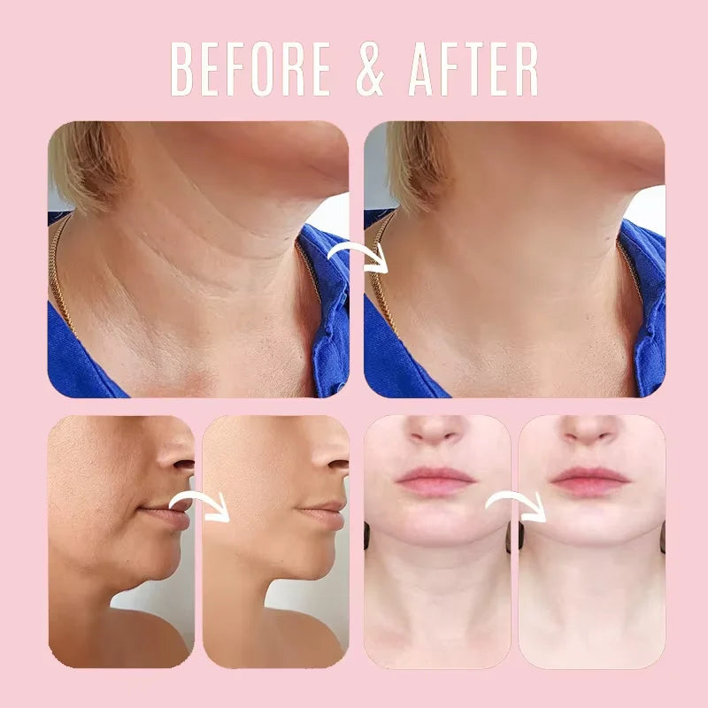 Collagen Wrinkle Removal