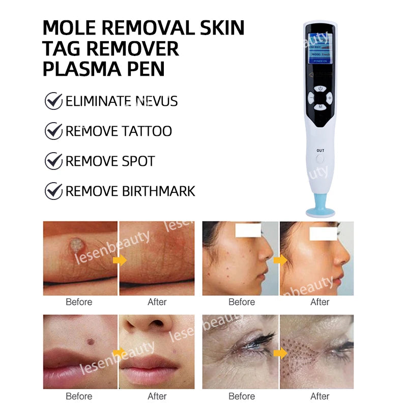 Laser Plasma Pen Machine 
Dark Spot Remover
Mole Tattoo Removal 
Pimples Removal Pen